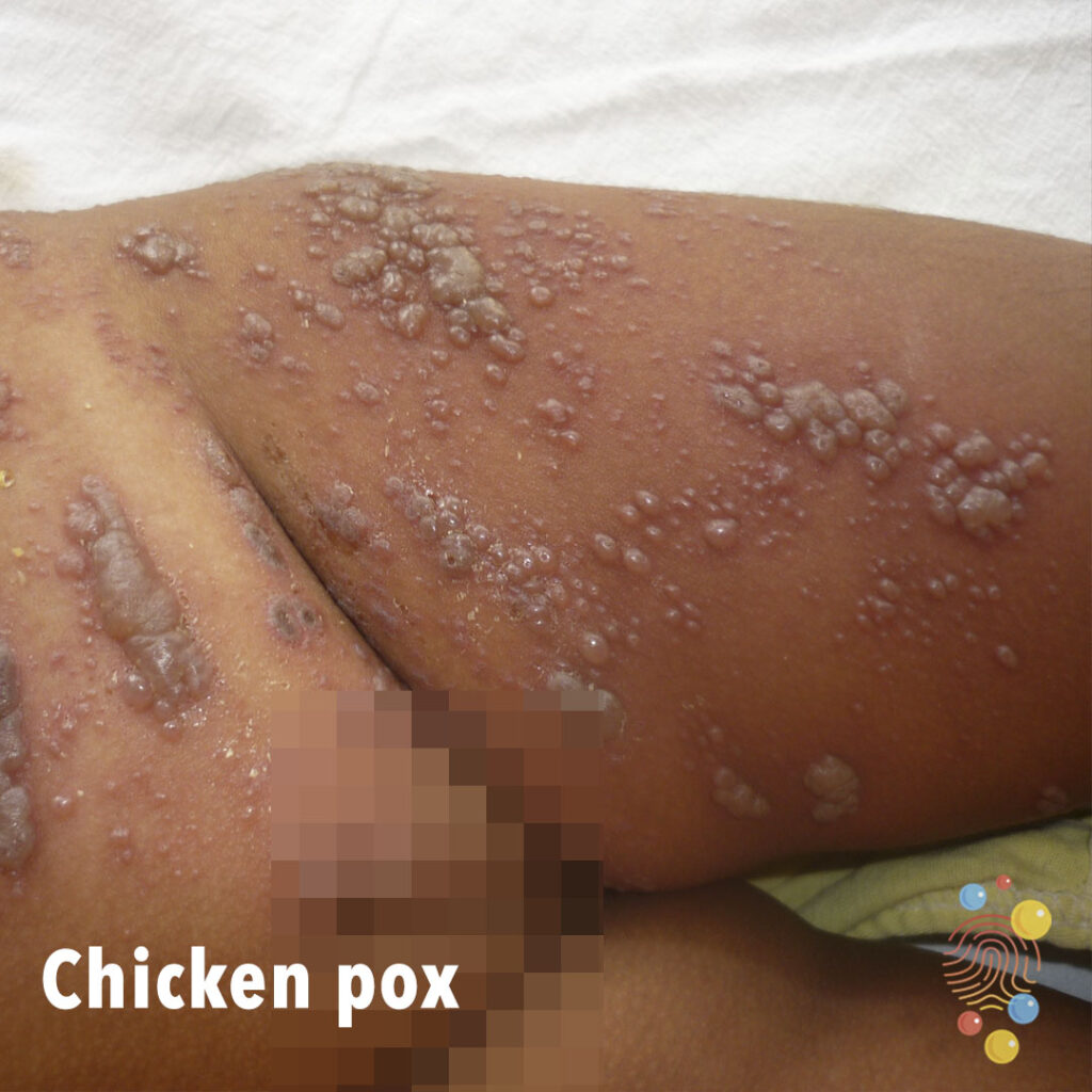 Chicken-pox2-skin deep.jpg