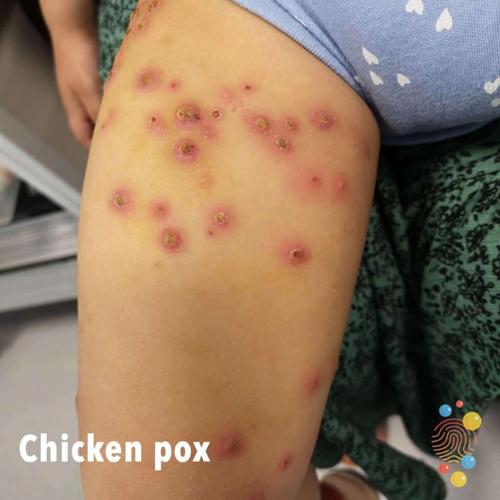 10-chicken-pox-.jpg