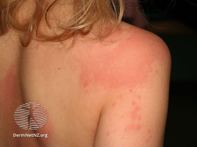 urticaria6.jpg