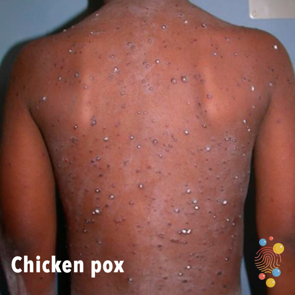 Chicken-pox-.jpg