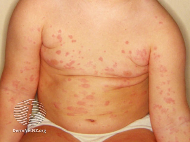 urticaria-051.jpg