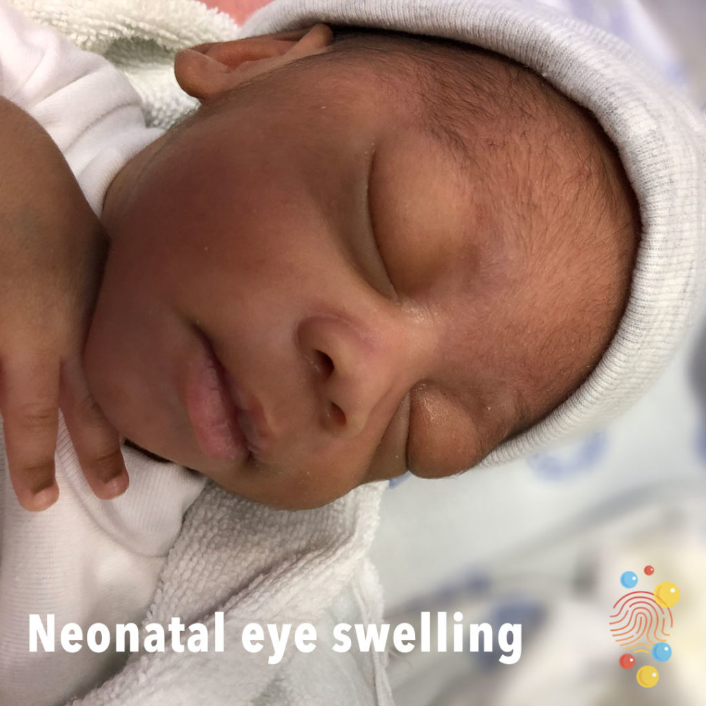 Neonatal-eye-swelling-skin deep.jpg