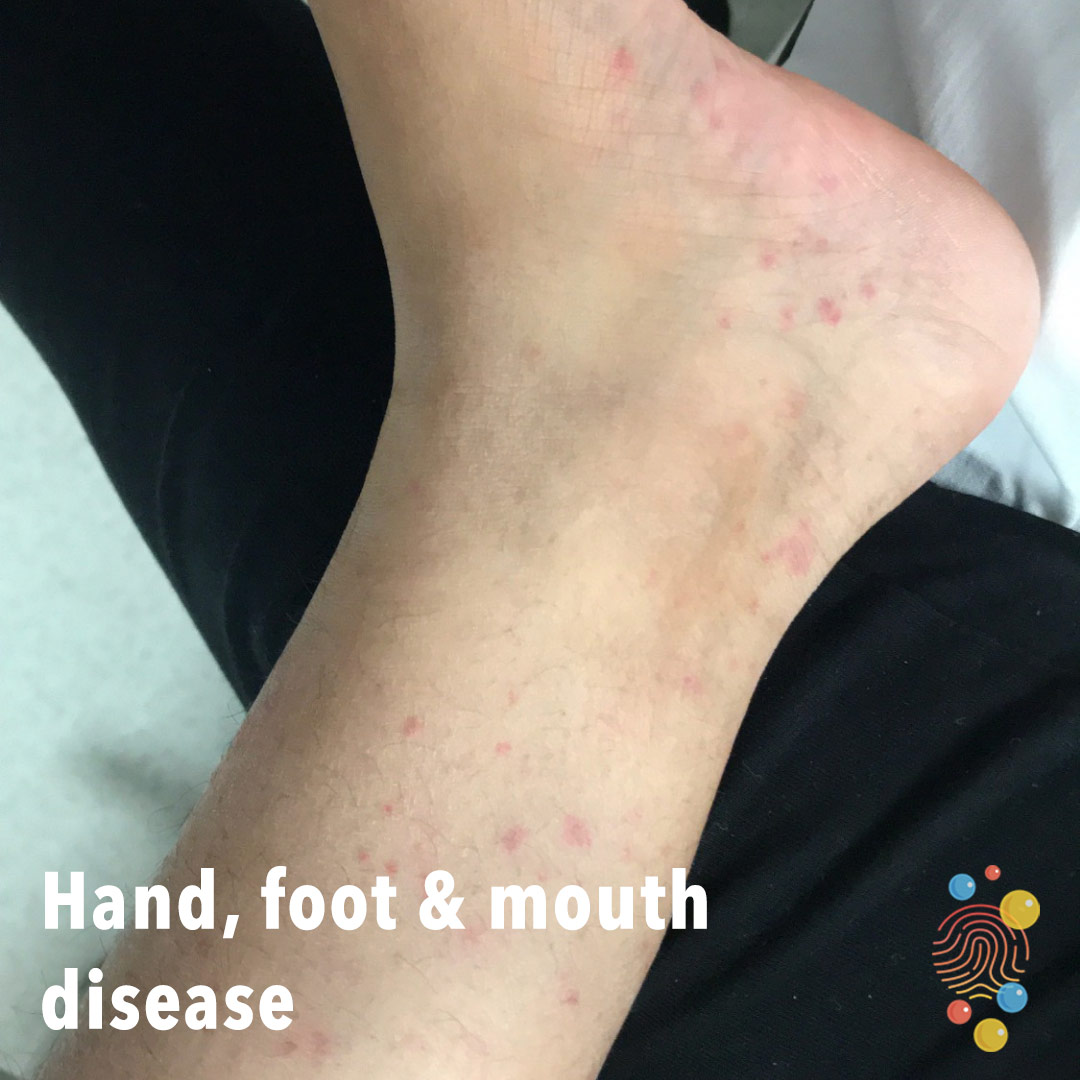 148b-hand-foot-and-mouth-disease.jpg